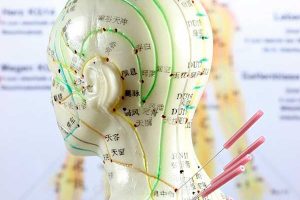 Acupuntura